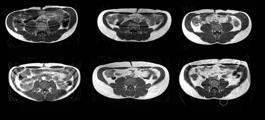 What's So Dangerous About Visceral Fat?